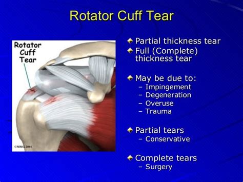 rotator cuff tear examination findings